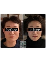 キュープ 浜松店(Qpu)/40代、お悩み：エラ張り