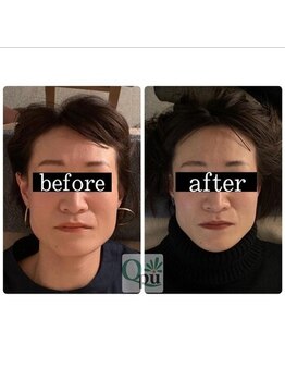 キュープ 浜松店(Qpu)/40代、お悩み:エラ張り