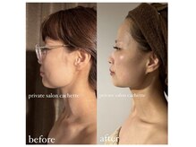 カシェット(cachette)/ウルトラ小顔フェイシャル