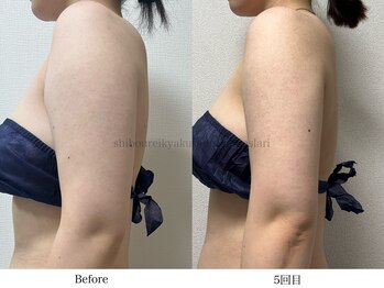 スラリ(SLARI)/【二の腕　脂肪冷却】期間2か月