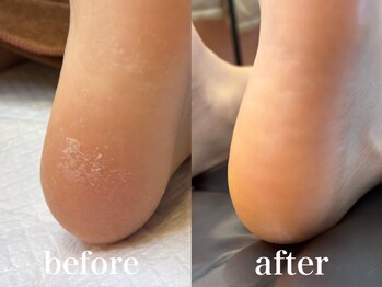 ドクターネイル爪革命 札幌本店/症例紹介28 角質ケア