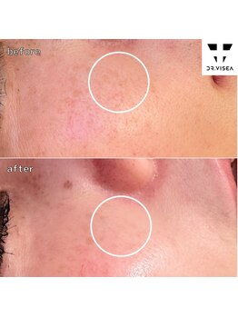 エミリー 守山(EMILY)/【症例写真】シミ取リ放題 (5)