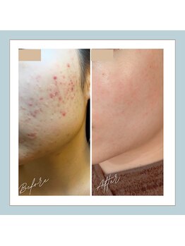 ラシュレ(BEAUTY CONCIERGE RASSURER)/ニキビ、赤み、凸凹にND-R！