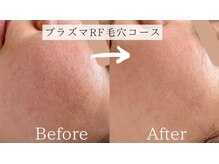 ナチュラル グロウ 木更津(NATURAL GLOW)/毛穴撃退コース