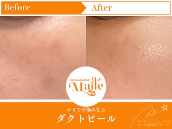 まいれ鍼灸院整骨院 整体院 草津院/ダクトピール/しみ