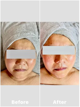 ブルームオーラ 月(BLOOM AURA)/カッサヘッドスパ・小顔・幹細胞