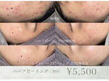 ベネミー 恵比寿(Benemi)の雰囲気（ハーブピーリング￥5,500でニキビケア、毛穴ケアができます。）