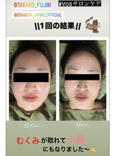 アローナ(ARONA)/VOSサロンケア一度でこの効果！