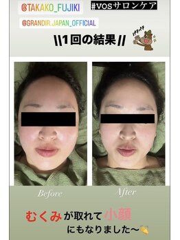 アローナ(ARONA)/VOSサロンケア一度でこの効果！