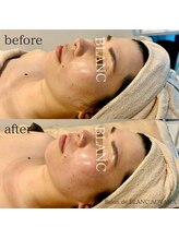 サロン ド ブラン アオヤマ(Salon de BLANC AOYAMA)/リフトアップで輪郭も整える