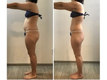 カリス/全身4回ビフォーアフター