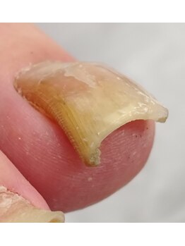 刺さっていた部分も一回で改善