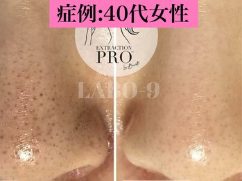 ラボキュー(LABO-9)/40代女性毛穴症例写真