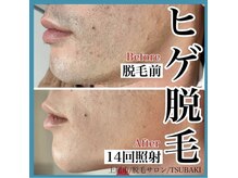 ツバキ(TSUBAKI)/ヒゲ脱毛