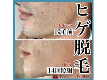 ツバキ(TSUBAKI)/ヒゲ脱毛