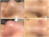 プラズマニードルで毛穴引き締め&ハイドラ毛穴洗浄で毛穴黒ずみや皮脂も撃退!
