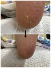 フロー(Froh)/かかとの角質