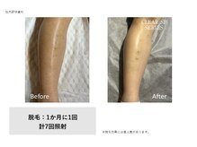サロン ルアナ(salon luana)/脚脱毛before→after