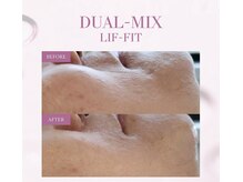 レアビューティー(Le'a beauty)/生リジュラン導入