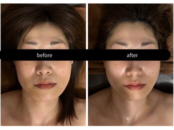 ビノスビューティー(vinos.beauty)/症例写真　小顔矯正　小倉　小顔