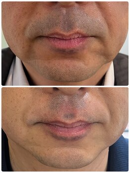 ピンクマジック(PINKMAGIC)/ヒゲ脱毛ビフォアフ