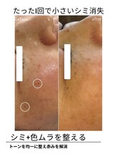 エイチケービューティーサロン(H/K beauty salon)/【小さいシミ】