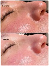 ブライズ(BRISE)/W幹細胞フェイシャル