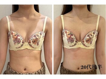 リール 新宿店(RIRE)/20代後半 バストアップ症例