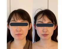 ハイコガオ(HIKOGAO)/小顔矯正60分