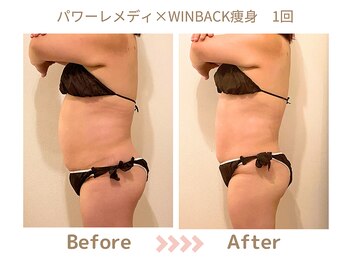リトリト(Retreat)/痩身コース1回ビフォーアフター
