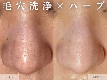 レヴェリー 心斎橋店(REVERIE)/-毛穴洗浄×ハーブ-
