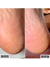 ベッレ マーニ/足裏角質ケア