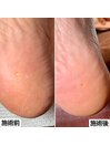 足裏角質ケア