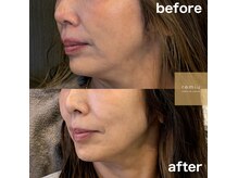 レミュー(remiu)/表情筋テラボーラー6回