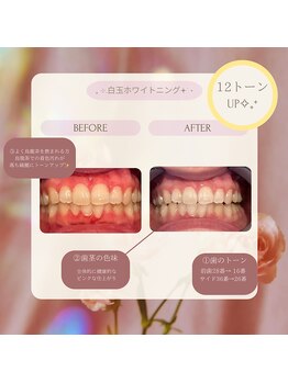 プラスビー 2号店(+b)/ホワイトニングビフォーアフター