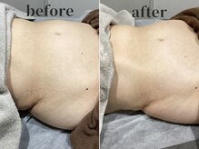 シンディー(CINDY)/腸もみビフォーアフター