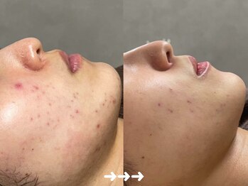 フロラスキン 銀座Miel店(florasKIN)/肌質改善プログラム