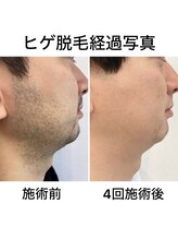 トイヴォ(TOIVO)/顔脱毛ビフォーアフター！