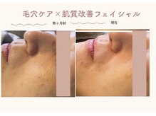 エステティックサロン シーズ/毛穴悩みを根本改善