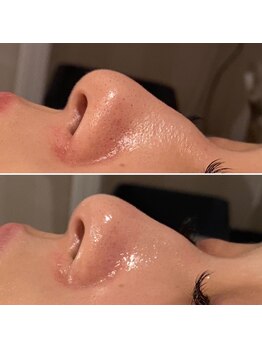 レアリゼ(Realiser)/クリスティーナの毛穴ぴかぴか☆