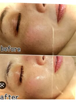 サナティオ(SANATIO)/ハーブピーリング