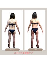 トレゾアスィス(Tresor sis)/痩身/ダイエット/筋膜リリース