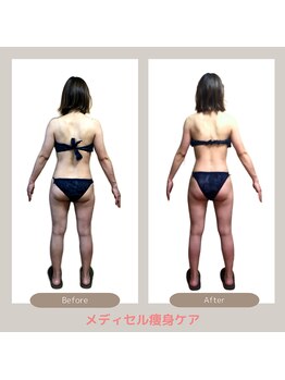 トレゾアスィス(Tresor sis)/痩身/ダイエット/筋膜リリース