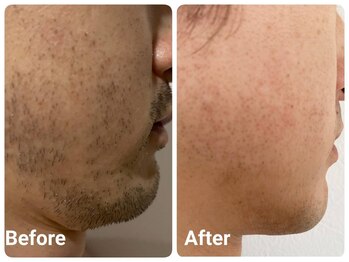 スマイルボディ つぼの森 加治木店(Smile body)/メンズひげ【WAX+光】