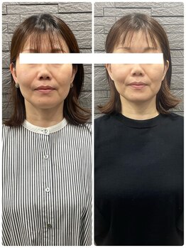 長寿鍼灸院 長寿整骨院/ハリネズミ女優美容鍼効果★