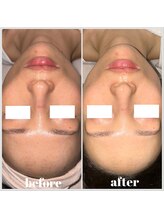 グロウズ(Glows)/美白プラピール