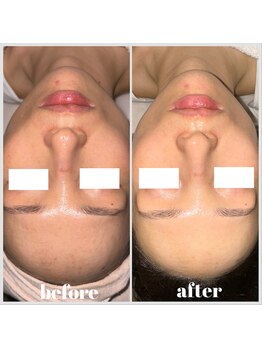 グロウズ(Glows)/美白プラピール