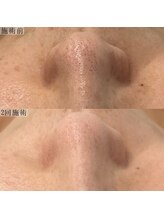 ヴェルシック(Belchic)/月1の施術でむくみと毛穴ケアを