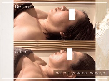 ヤワラ 長与店(yawara)/πテラピーBefore After