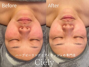 シエリー 原宿本店(Ciely)/ハーブピーリング/ハリ・美白